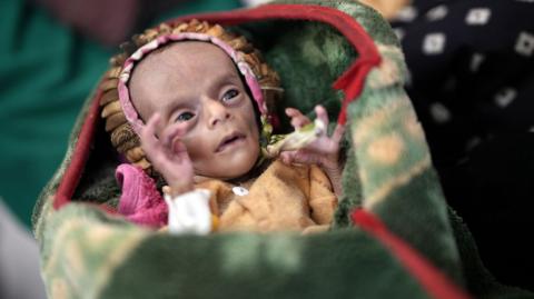 Malnourished twin Raad Hassan is held by his mother Lina while his sister Raghad lies beside him on a bed at a hospital in Aden, Yemen